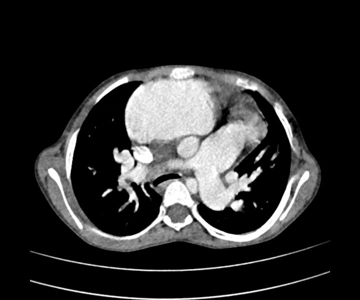 File:Atrial septal defect complicated by Eisenmenger syndrome (Radiopaedia 53707-59768 Axial C+ CTPA 12).jpg