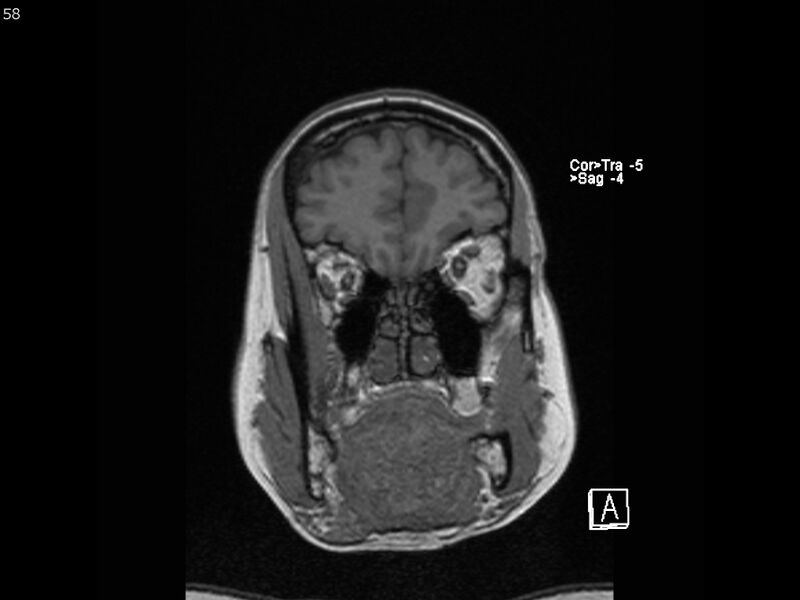 File:Atypical meningioma - intraosseous (Radiopaedia 64915-74572 Coronal T1 58).jpg