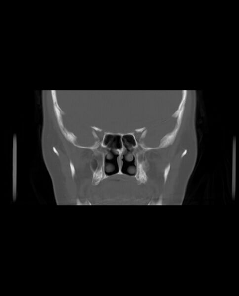 File:Automastoidectomy with labyrinthine fistula (Radiopaedia 84143-99411 Coronal non-contrast 52).jpg