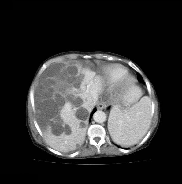 File:Autosomal dominant polycystic kidney disease (Radiopaedia 16777-16490 A 10).jpg
