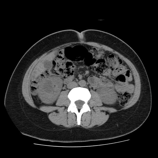 File:Autosomal dominant polycystic kidney disease (Radiopaedia 23061-23093 Axial non-contrast 36).jpg