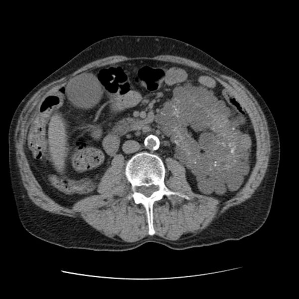 File:Autosomal dominant polycystic kidney disease (Radiopaedia 27851-28094 Axial non-contrast 75).jpg