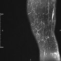 Avulsion fracture of the fibular head (Radiopaedia 74804-85808 Sagittal PD fat sat 2).jpg