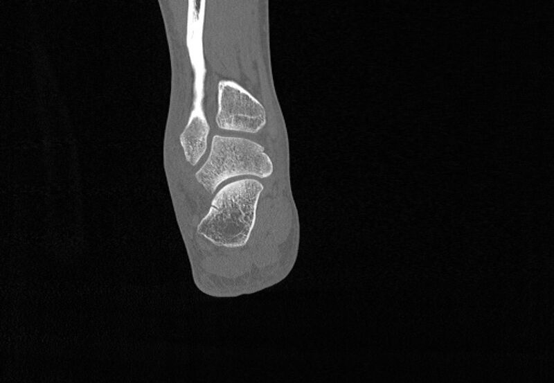 File:Avulsion fractures of talus and calcaneus (Radiopaedia 48277-53155 Coronal bone window 75).jpg