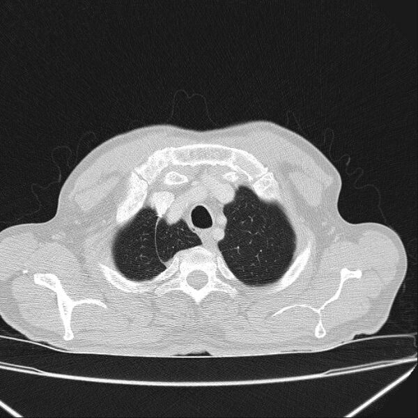 File:Azygos lobe (Radiopaedia 38259-40275 Axial lung window 9).jpg