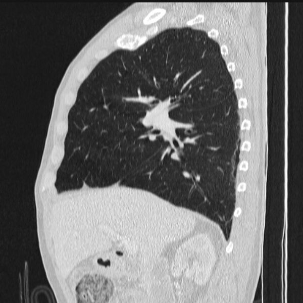 File:Azygos lobe (Radiopaedia 38259-40275 lung window 38).jpg