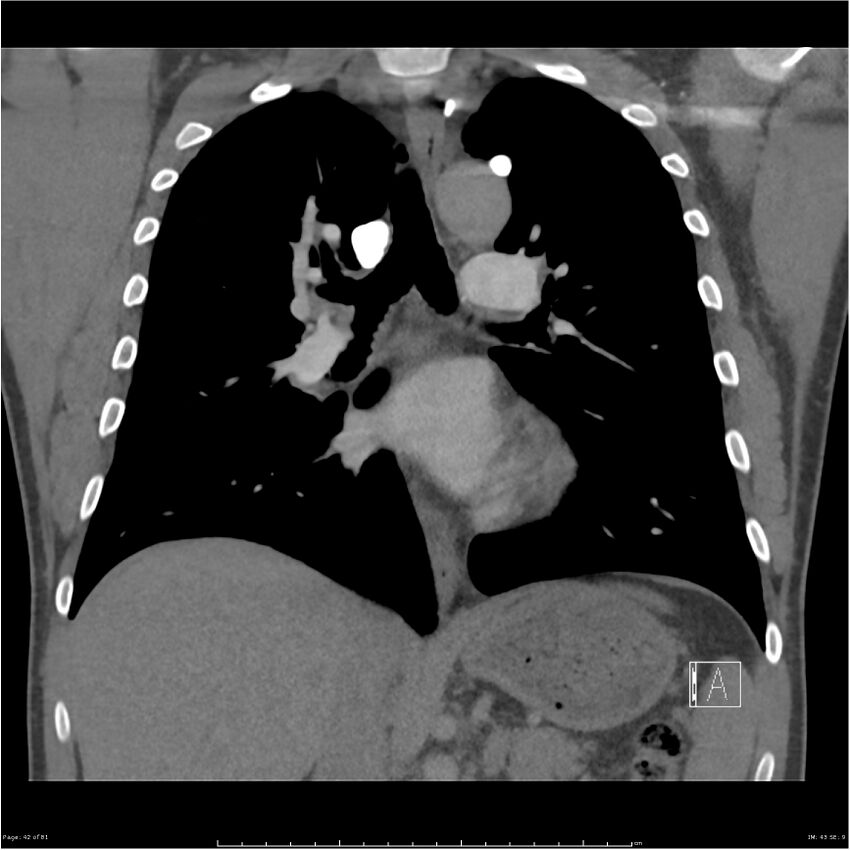 Azygos venous system anatomy (CT pulmonary angiography) (Radiopaedia 25928-26077 Coronal C+ CTPA 42).jpg