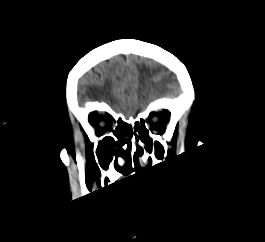 Basal ganglia hemorrhage (Radiopaedia 58766-65988 Coronal non-contrast 52).jpg