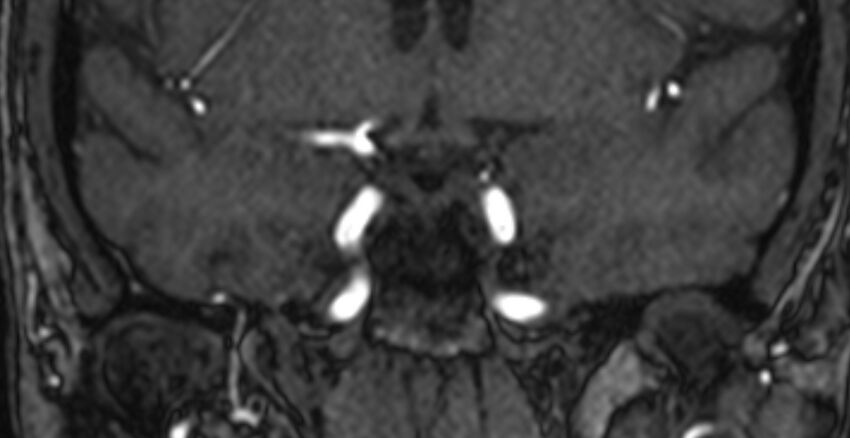 Basilar artery fenestration (Radiopaedia 74537-85455 Coronal MRA TOF 23).jpg