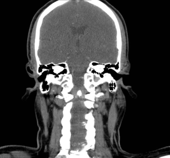 File:Benign mixed salivary tumor of the parotid gland (Radiopaedia 35261-36792 B 21).jpg