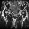 Benign prostatic hyperplasia (Radiopaedia 2586-6281 Coronal T2 1).jpg