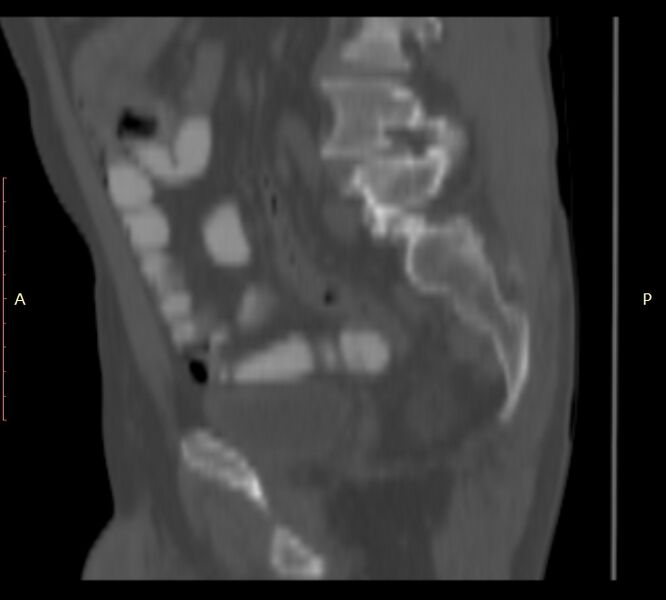 File:Bertolotti syndrome (Radiopaedia 58974-66235 Sagittal bone window 39).jpg