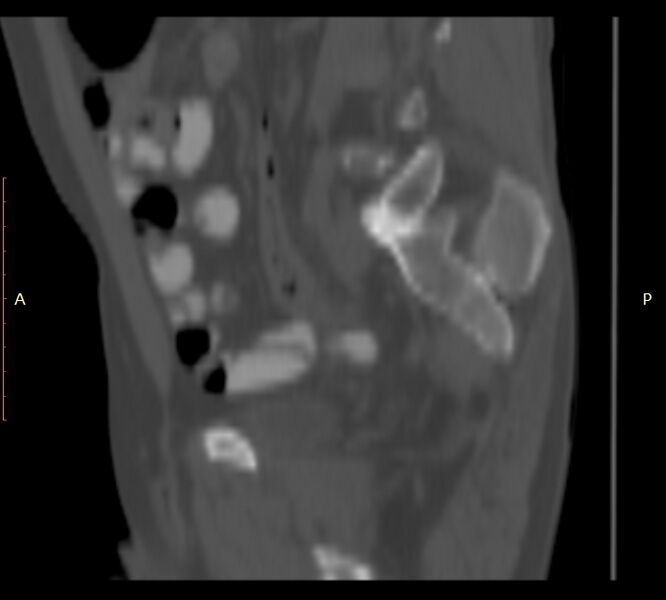 File:Bertolotti syndrome (Radiopaedia 58974-66235 Sagittal bone window 44).jpg