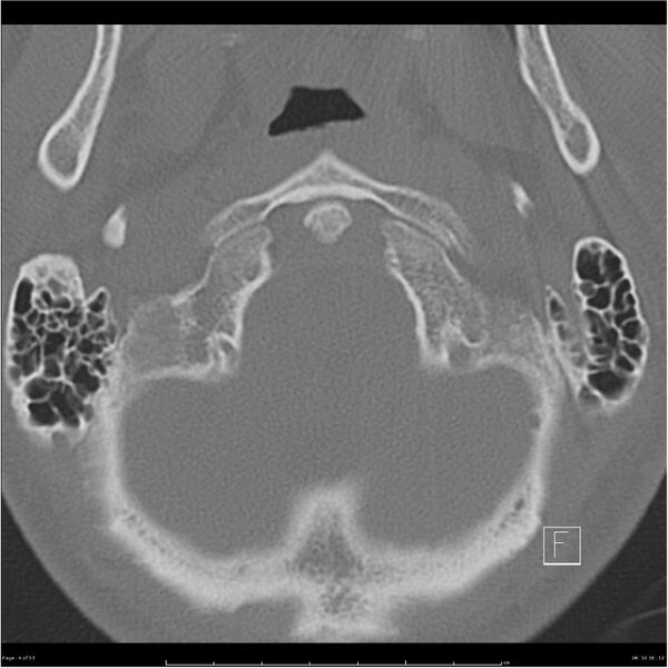 File:Bilateral cervical ribs (Radiopaedia 25868-26017 Axial bone window 4).jpg