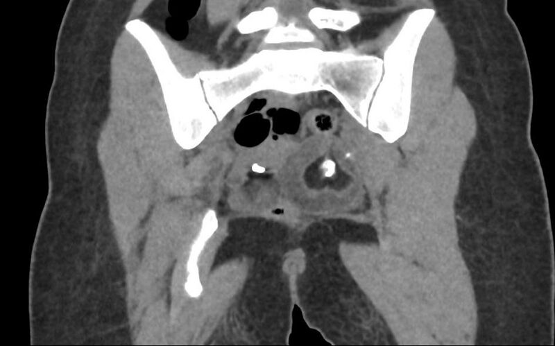 File:Bilateral mature cystic ovarian teratoma (Radiopaedia 88821-105592 Coronal non-contrast 27).jpg