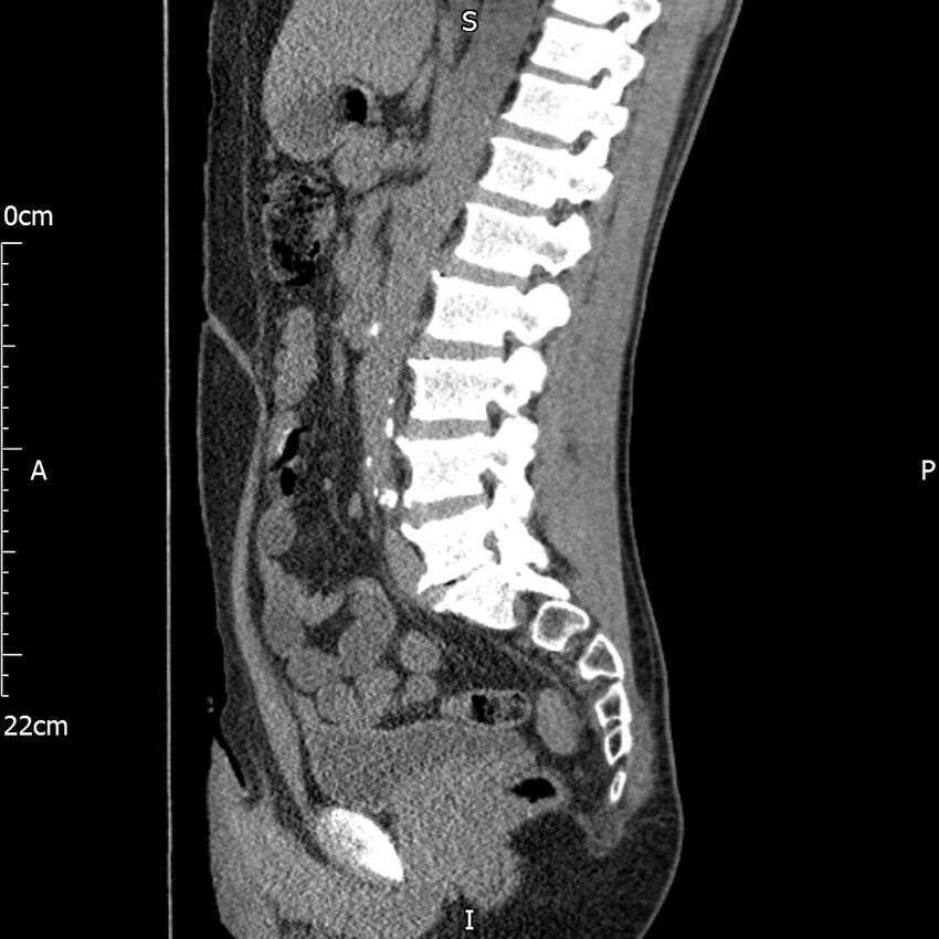 Bilateral medullary nephrocalcinosis with ureteric calculi (Radiopaedia 71269-81569 C 56).jpg