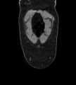 Bilateral ovarian mature cystic teratomas (Radiopaedia 79373-92457 B 2).jpg
