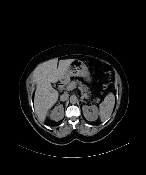 File:Bilateral sporadic synchronous clear cell renal cell carcinoma (Radiopaedia 85035-100572 Axial non-contrast 20).jpg
