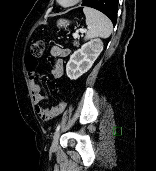 File:Bilateral sporadic synchronous clear cell renal cell carcinoma (Radiopaedia 85035-100575 G 30).jpg