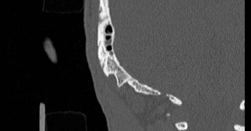 Bilateral temporal bone fractures (Radiopaedia 29482-29970 Coronal non-contrast 192).jpg