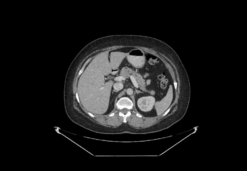 File:Bilateral urolithiasis with incidentally detected splenic artery aneurysm and left inferior vena cava (Radiopaedia 44467-48127 B 18).jpg