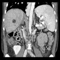 Biliary necrosis - liver transplant (Radiopaedia 21876-21846 C 30).jpg