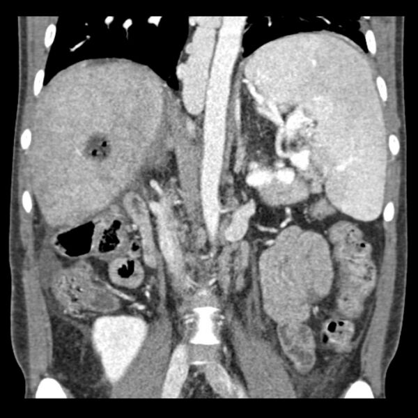 File:Biliary necrosis - liver transplant (Radiopaedia 21876-21846 C 30).jpg
