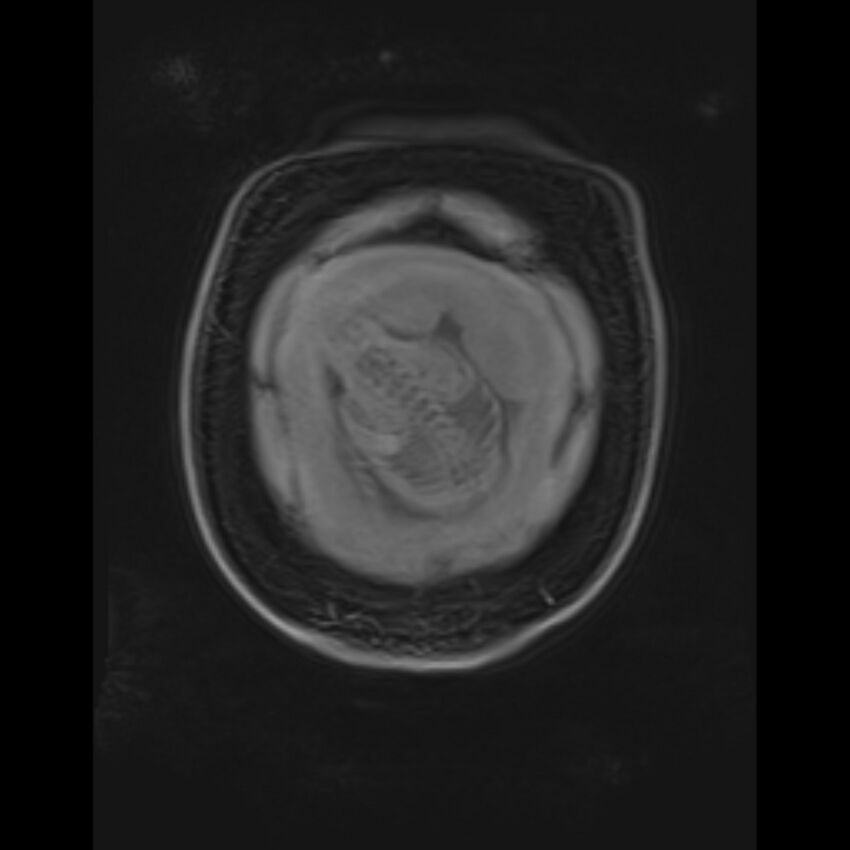 Bilobed placenta accreta (Radiopaedia 69648-79591 Coronal T1 vibe 20).jpg