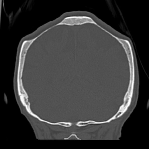 File:Biparietal osteodystrophy (Radiopaedia 46109-50463 Coronal bone window 81).jpg