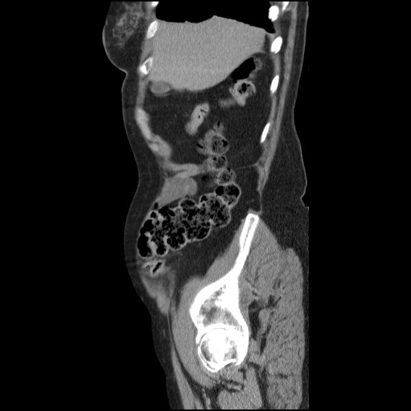 File:Bladder tumor detected on trauma CT (Radiopaedia 51809-57609 E 61).jpg