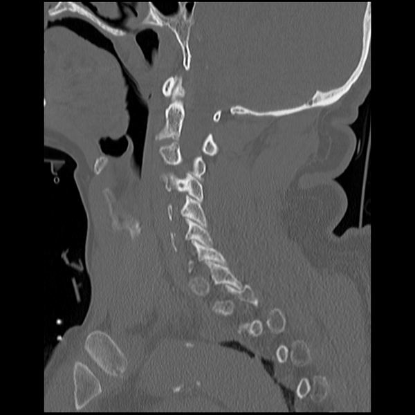 File:Blunt cerebrovascular injury (Radiopaedia 53682-59743 Sagittal bone window 7).png