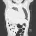 Bochdalek diaphragmatic hernia (Radiopaedia 38866-41059 Coronal lung window 7).jpg