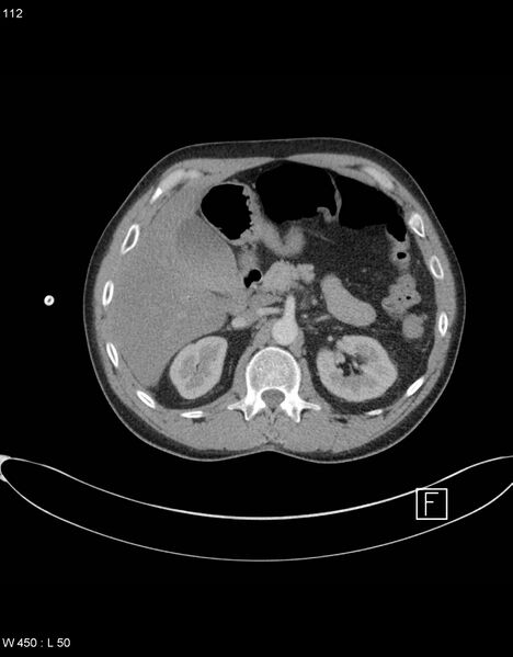File:Boerhaave syndrome with tension pneumothorax (Radiopaedia 56794-63605 A 55).jpg