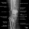 Bone lesion differential diagnosis - illustrations (Radiopaedia 79247-94246 A 1).jpg