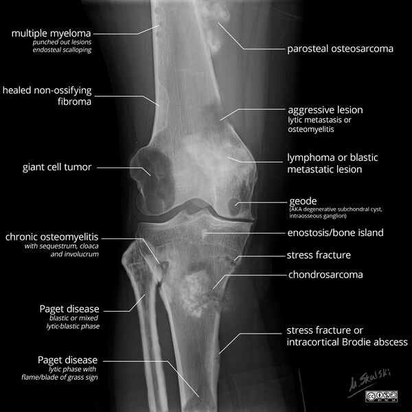 File:Bone lesion differential diagnosis - illustrations (Radiopaedia 79247-94246 A 1).jpg