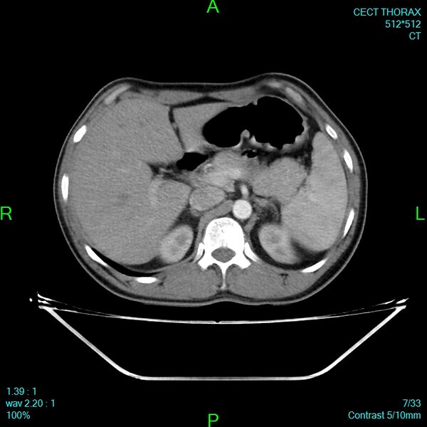 File:Bone metastases from lung carcinoma (Radiopaedia 54703-60937 Axial C+ delayed 7).jpg