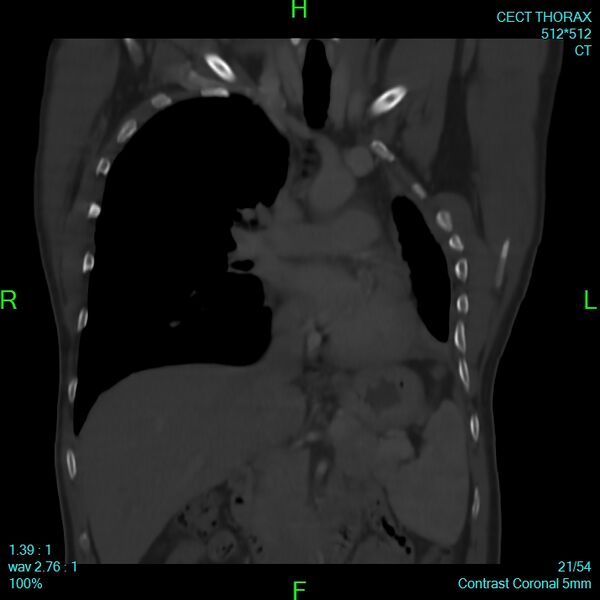 File:Bone metastases from lung carcinoma (Radiopaedia 54703-60937 Coronal bone window 21).jpg