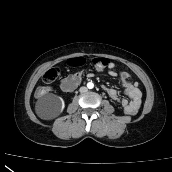 File:Bosniak renal cyst - type I (Radiopaedia 27479-27675 renal cortical phase 46).jpg