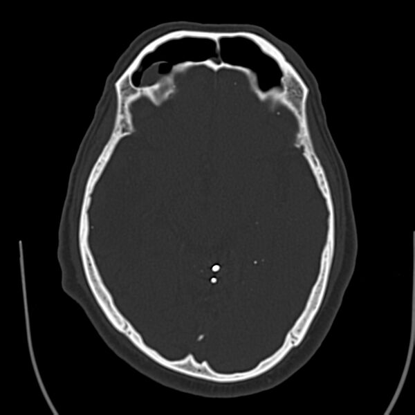 File:Brain Pantopaque remnants (Radiopaedia 78403-91048 Axial bone window 33).jpg