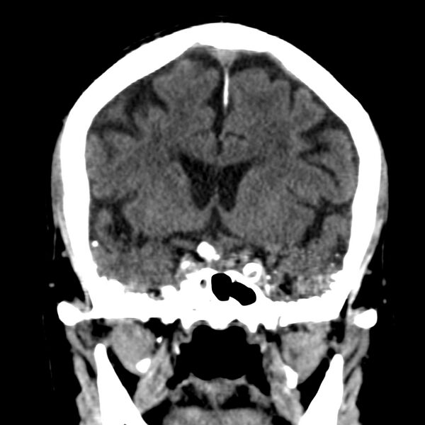File:Brain Pantopaque remnants (Radiopaedia 78403-91048 Coronal non-contrast 30).jpg