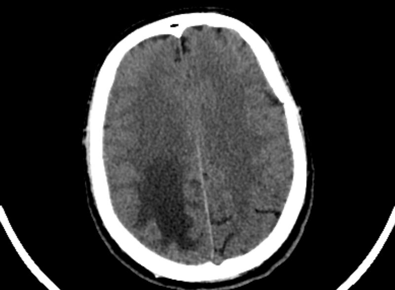 File:Brain abscess complicated by intraventricular rupture and ventriculitis (Radiopaedia 82434-96575 Axial non-contrast 85).jpg