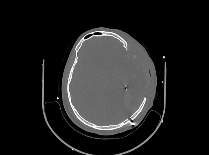 File:Brain injury by firearm projectile (Radiopaedia 82068-96087 A 109).jpg