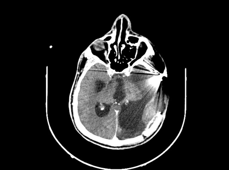 File:Brain injury by firearm projectile (Radiopaedia 82068-96088 B 118).jpg
