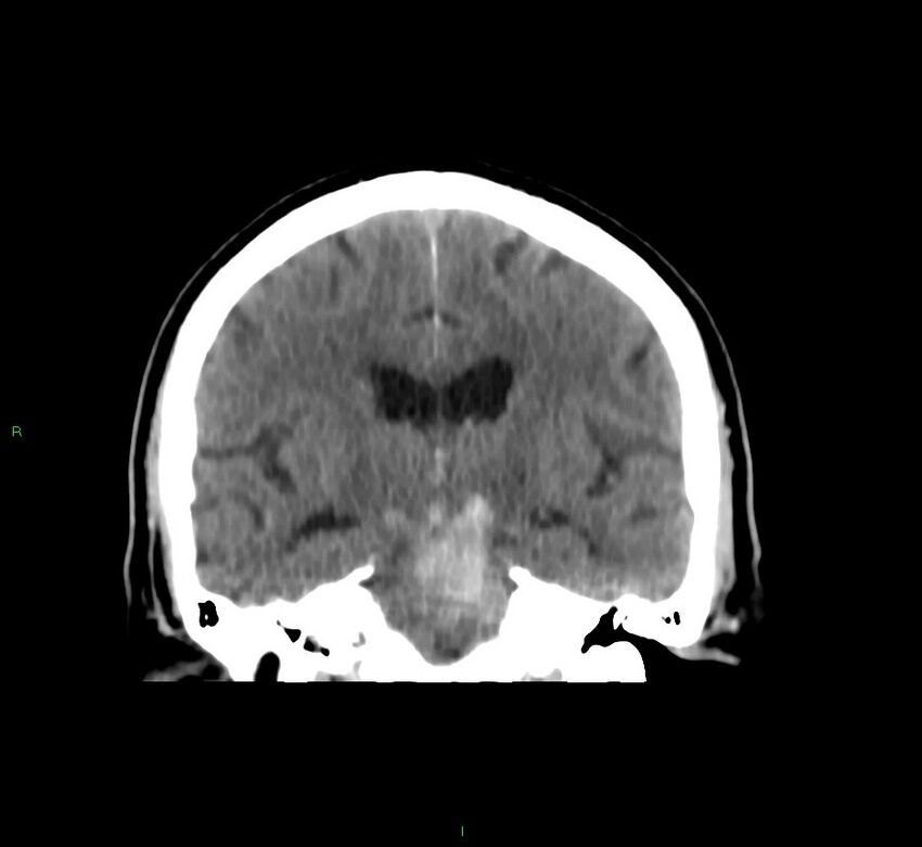 Brainstem hemorrhage (Radiopaedia 58794-66028 Coronal non-contrast 33).jpg