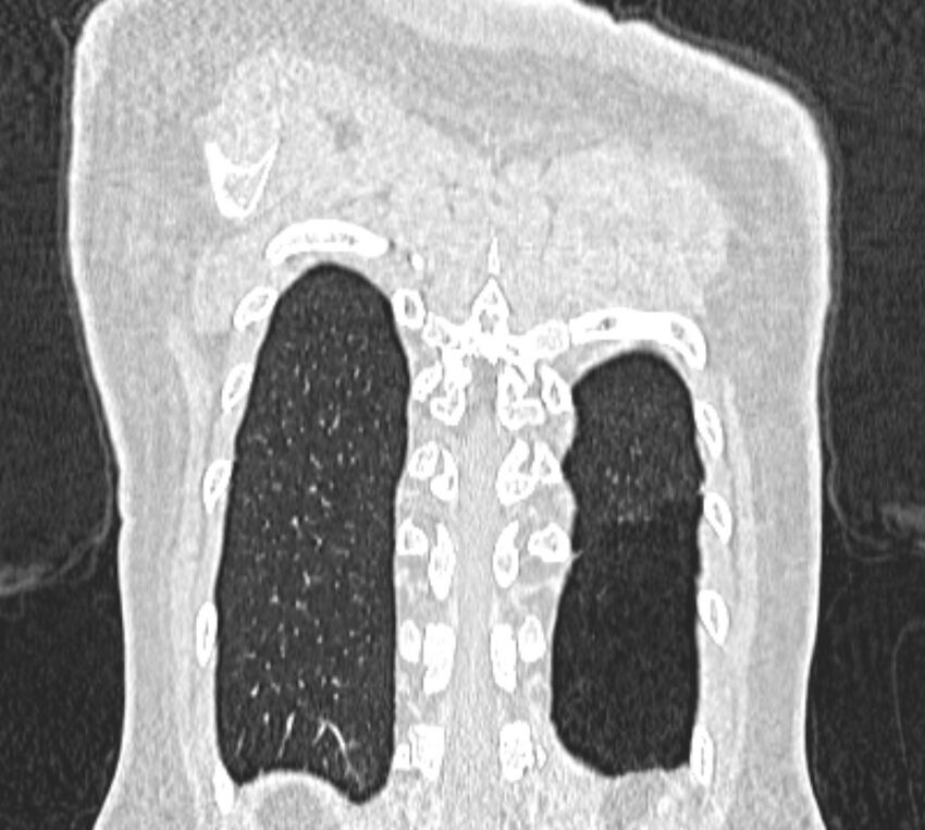 Bronchial atresia (Radiopaedia 50007-55297 Coronal lung window 107).jpg