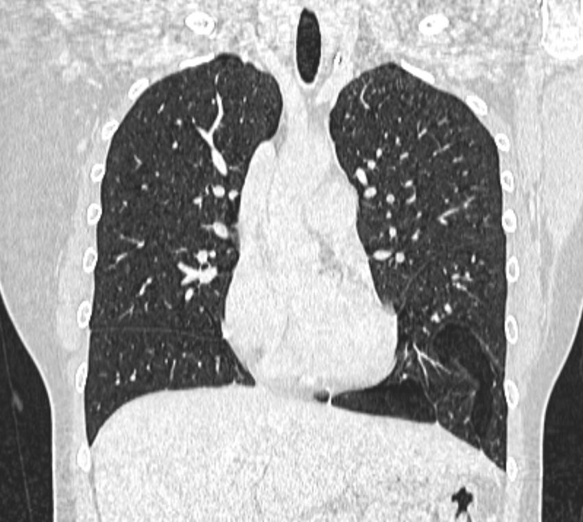 Bronchial atresia (Radiopaedia 50007-55297 Coronal lung window 41).jpg