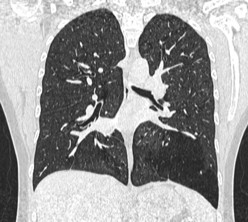Bronchial atresia (Radiopaedia 50007-55297 Coronal lung window 63).jpg