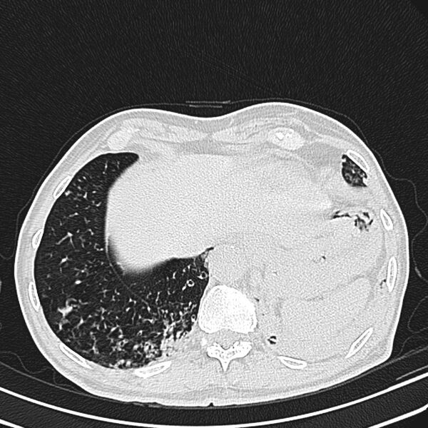 File:Bronchiectasis (Radiopaedia 22061-22059 lung window 25).jpg