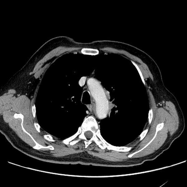 File:Bronchogenic carcinoma with L1 vertebra metastasis (Radiopaedia 9096-9805 Axial C+ delayed 8).jpg