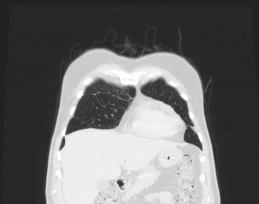 Bronchogenic carcinoma with lymphangitic spread (Radiopaedia 29002-29357 Coronal lung window 7).jpg